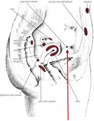 endometriosi